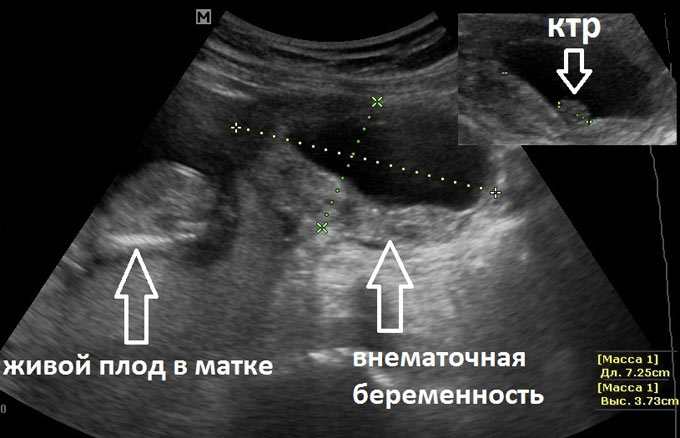 Беременность эктопическая (ectopic pregnancy), беременность внематочная (extrauterine pregnancy)