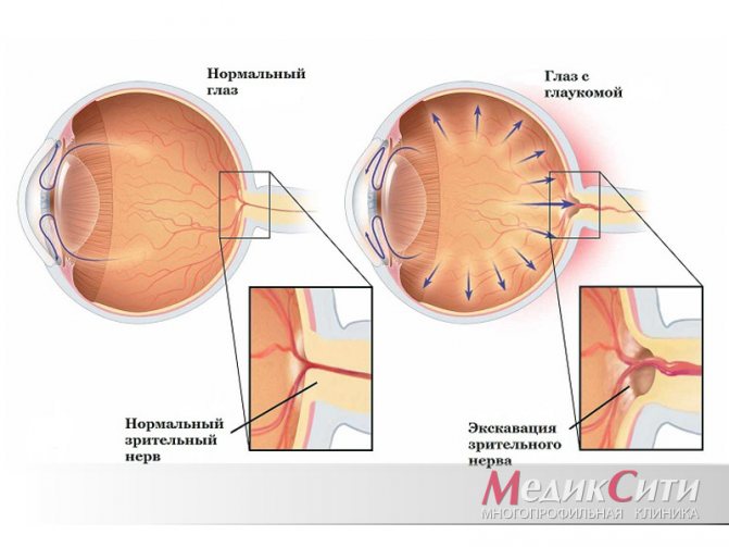 Норма глазного давления при глаукоме: как снизить высокие показатели