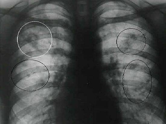 Можно ли заразиться закрытой формой туберкулеза легких и насколько это опасно для окружающих