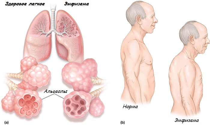 Причины деформации позвоночника и грудной клетки