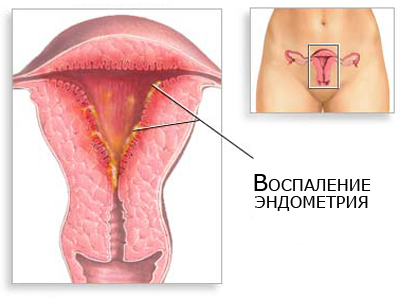 Полип эндометрия матки: причины, симптомы, как лечить