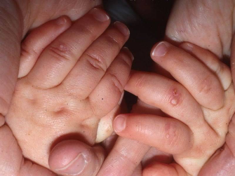 Красные пятна на теле у ребенка: фото с описанием