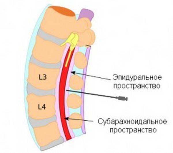 Картинки спинальная анестезия