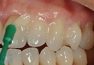 Настоящие зубы. ученые смогли восстановить эмаль