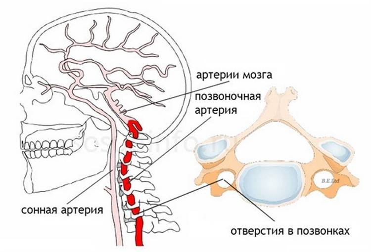 Синдром позвоночной артерии при шейном остеохондрозе