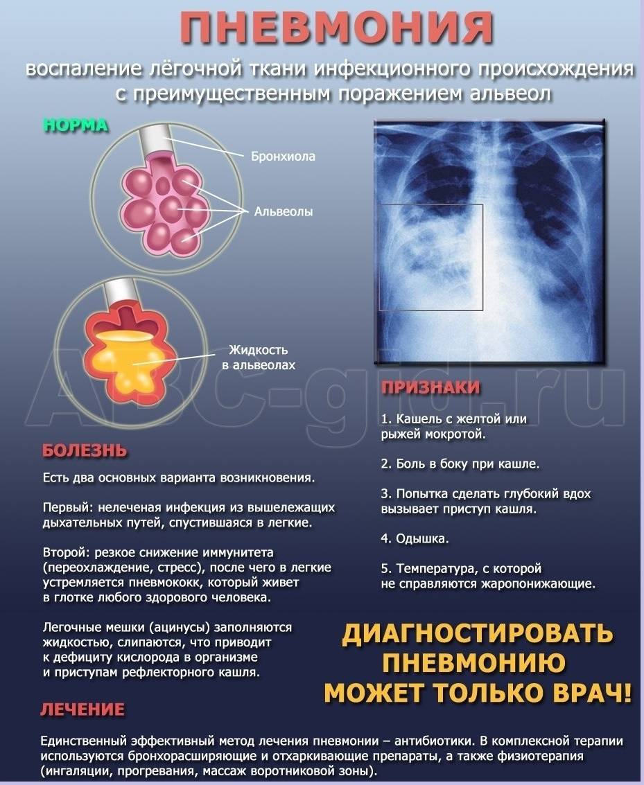Особенности профилактики пневмонии