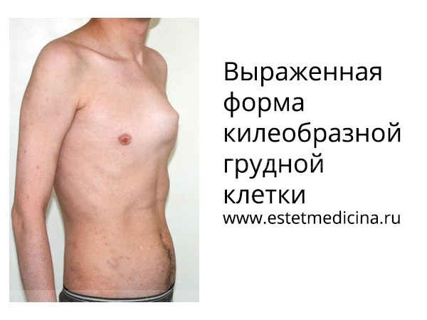 Деформация грудной клетки у детей