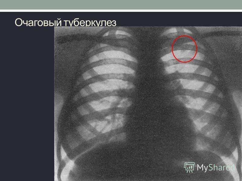 Каким путем происходит заражение туберкулезом легких – как передается палочка коха