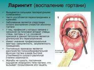 Ларингит: симптомы и лечение у взрослых в домашних условиях