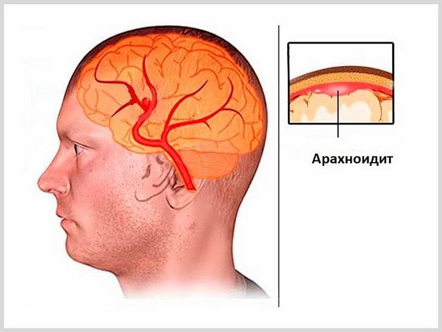 Арахноидальная киста – причины, симптомы, диагностика, лечение