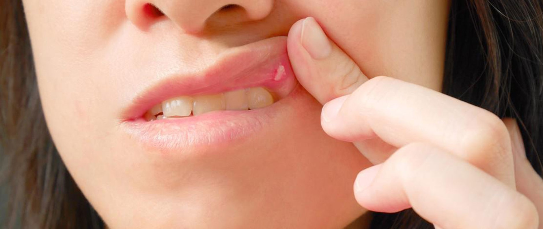 Стоматит во рту у взрослых  как лечить стоматит на губе, языке?
