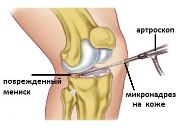 Повреждение и разрыв мениска коленного сустава: диагностика и лечение