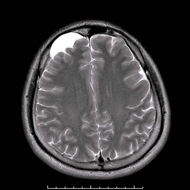 Признаки и лечение арахноидальной ликворной кисты головного мозга