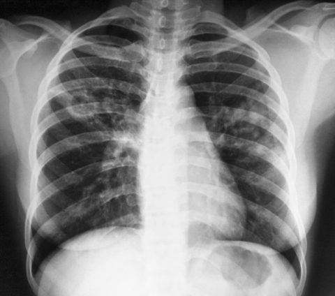 Туберкулез лёгких — признаки на ранних стадиях, симптомы, формы, лечение у взрослых и профилактика