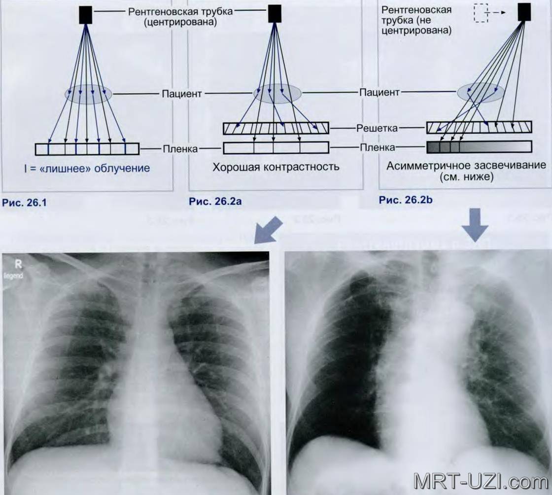 Покажет ли флюорография воспаление лёгких