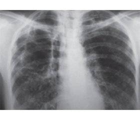 Многообразие форм туберкулеза легких и внелегочного туберкулеза. формы открытые и закрытые