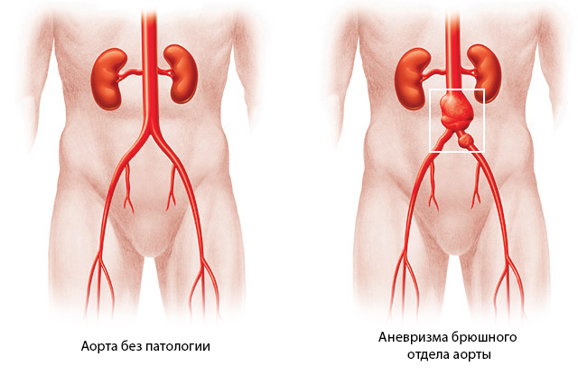 Аневризма грудного отдела аорты: диагностика и лечение