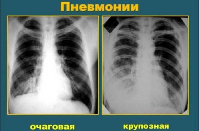 Чем отличается флюорография от рентгена лёгких: в каких случаях применяют