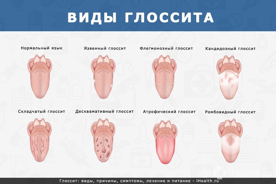 Воспаление сосочков на корне и кончике языка, причины увеличения (гипертрофии)