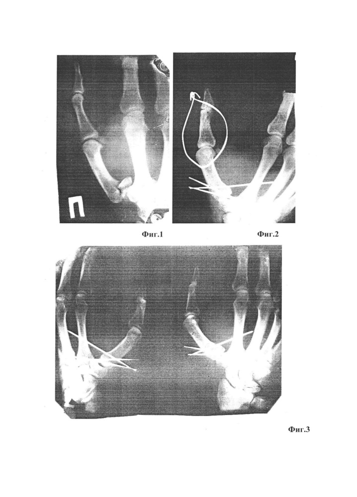 Перелом лучевой кости руки: лечение, срок срастания и реабилитация