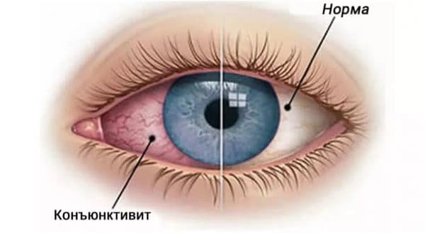 Желтые белки глаз: причины, лечение