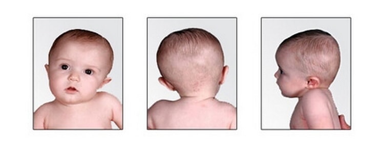 Кривошея у новорожденных и грудничков: первые признаки и лечение
