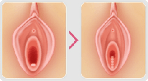 Коррекция опущения половых органов и несостоятельности мышц тазового дна