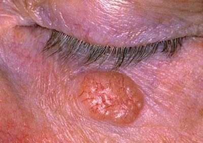 Базалиома кожи носа и лица: симптомы и лечение