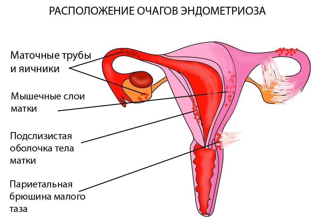 Жанин при эндометриозе: схема приема препарата (сколько пить)