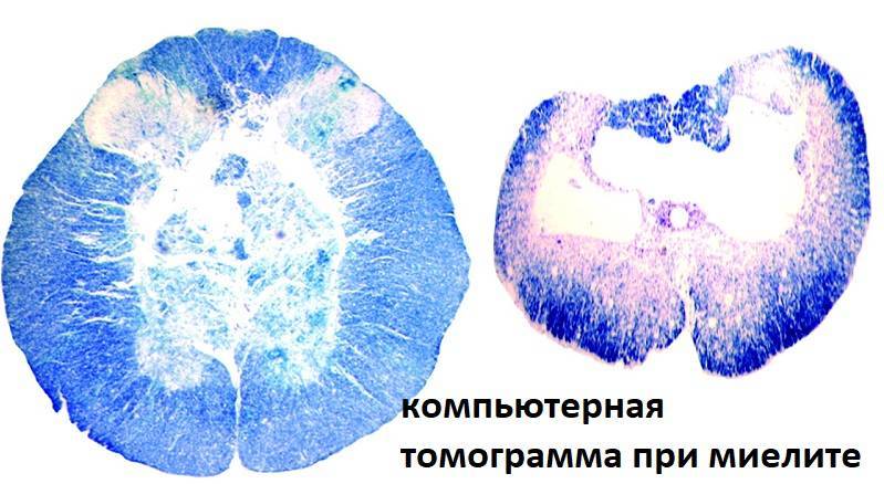 Миелит (воспаление) спинного мозга. миелит