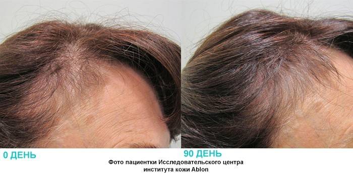 Биотин для волос: препарат от выпадения, перхоти и тусклости