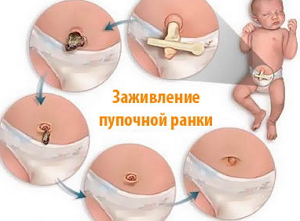 Пупок  кровит у новорожденного - пупок у новорожденного кровит - запись пользователя белла (belochkaislon) в сообществе здоровье новорожденных в категории разное - babyblog.ru