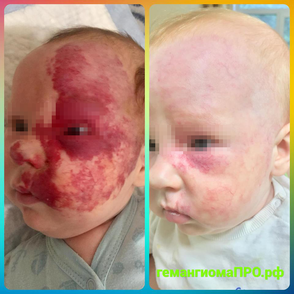 Гемангиома на коже у ребенка: причины возникновения и лечение