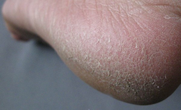 Микоз гладкой кожи: симптомы и лечение