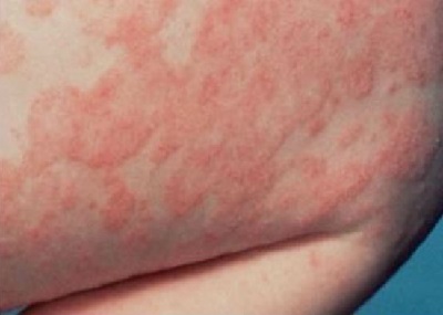 Особенности и лечение токсико-аллергического дерматита
