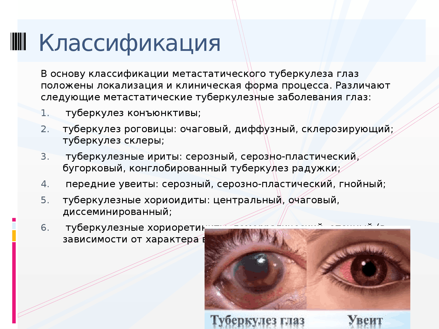 Лечение глазных заболеваний. Кератит – воспаление роговицы глаза.. Туберкулезные заболевания глаз.