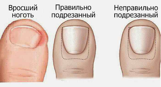 Как удалить ноготь на пальце ноги: вросший, пораженный грибком