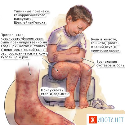 Геморрагический васкулит у детей