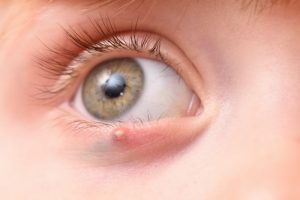 Халязион на глазу: что это такое, как и чем лечить это заболевание