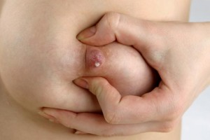 Выделения из грудных желез у женщин при надавливании желтого, белого, зеленого цвета. причины перед месячными, во время беременности, при климаксе