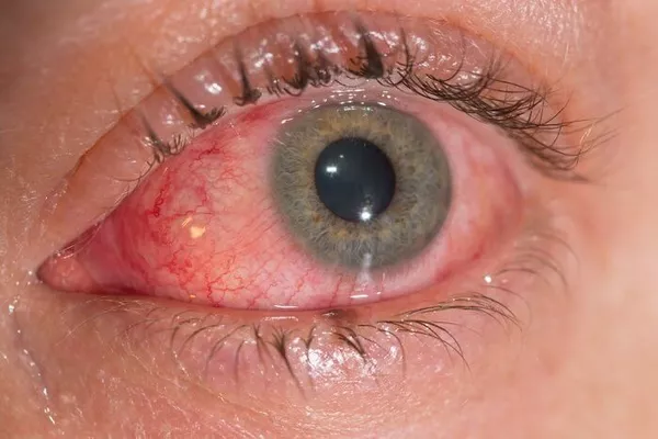 Кератит – виды, причины, симптомы и лечение воспаления глаза