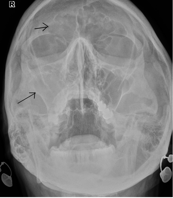 Катаральный гайморит. Фронтит рентген на снимке. Лобные пазухи рентген гайморит. Верхнечелюстной синусит рентген.