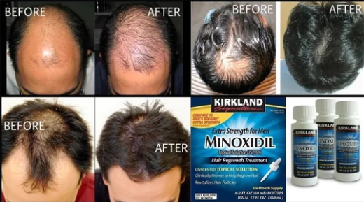 Миноксидил для волос: как действует, эффективность, фото до и после, отзывы. как применять женщинам и мужчинам, побочные эффекты, возможный вред. цена и отзывы