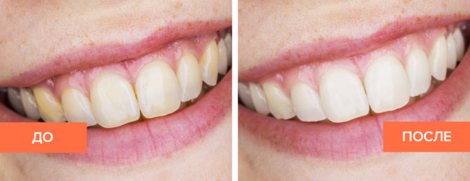 Отбеливание зубов: вред и польза самых действенных методов