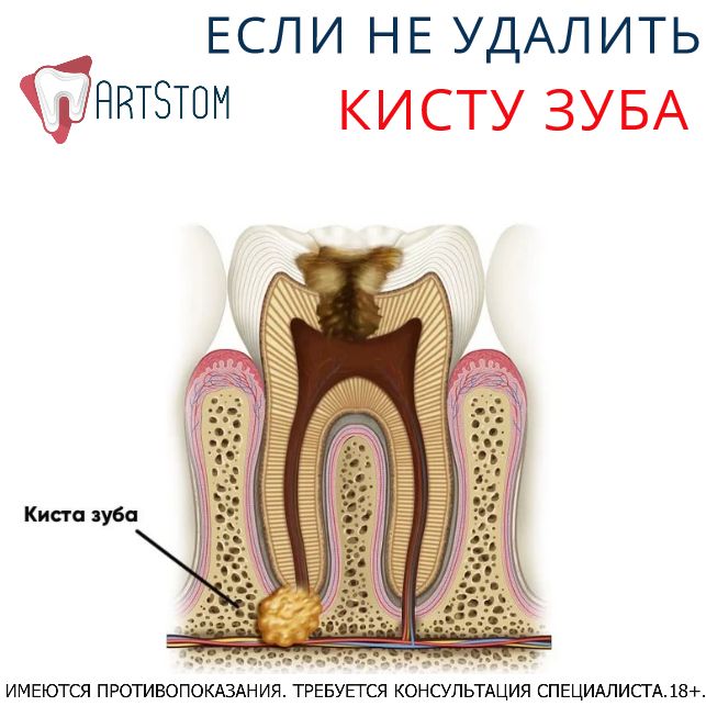 Киста в зубе – что это такое? виды, причины и симптомы, способы лечения