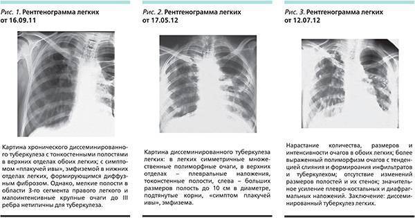 Туберкулез при беременности и родах: формы, анализы, симптомы, лечение и последствия