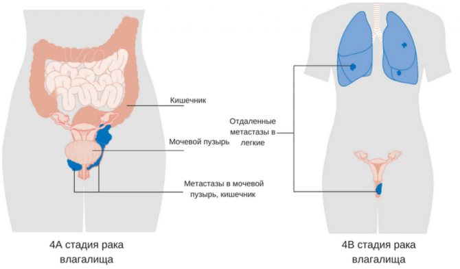 Опущение и выпадение внутренних половых органов (пролапс гениталий)