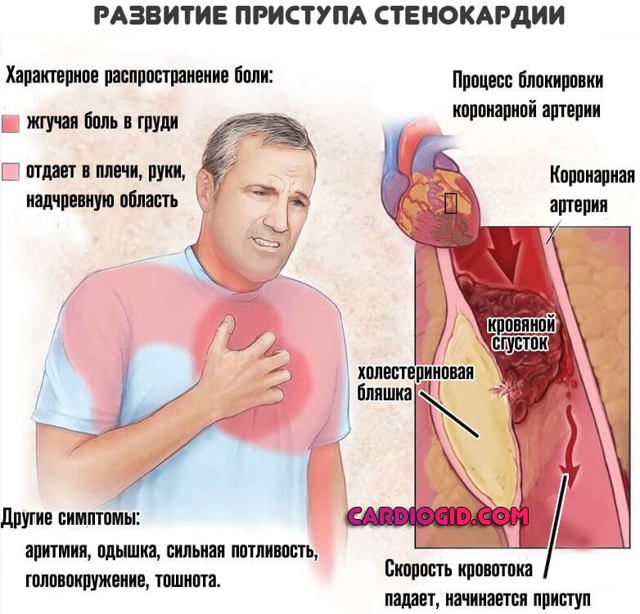 Первые признаки и симптомы инфаркта у мужчин (предынфарктное состояние): что нужно знать?