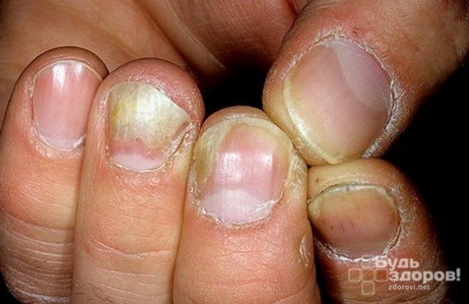 Самые быстрые способы лечения грибка ногтей медикаментозными и народными средствами