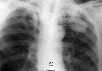 Удаление туберкуломы